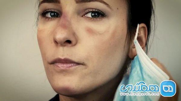 به حداقل رساندن آسیب های پوستی هنگام دویدن با ماسک صورت